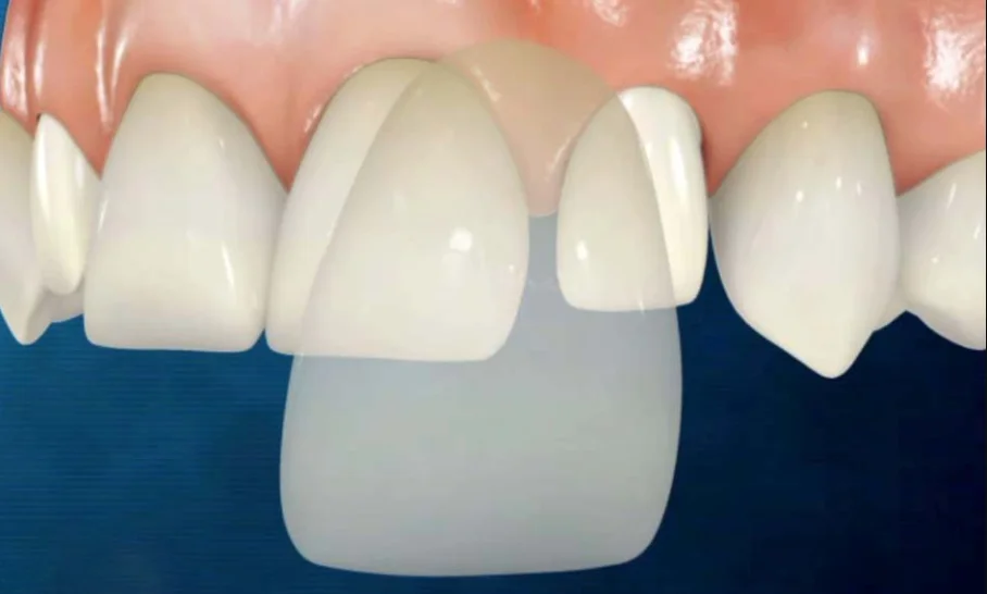 ¿Hay que desgastar los dientes para colocar carillas dentales?