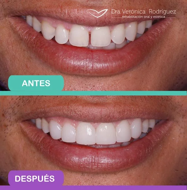 diseno-de-sonrisa-antes-y-despues-1