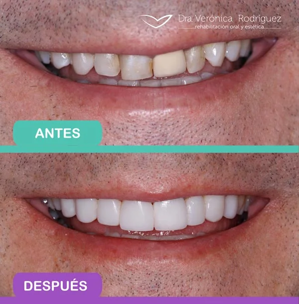 diseno-de-sonrisa-antes-y-despues-2