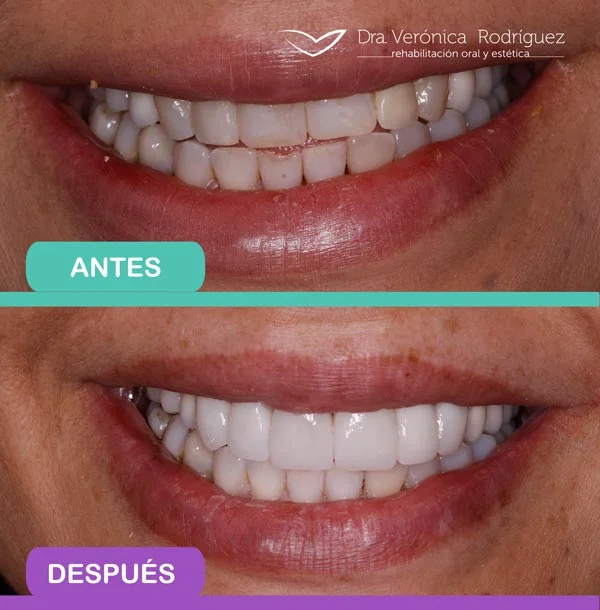 diseno-de-sonrisa-antes-y-despues-4 (1)