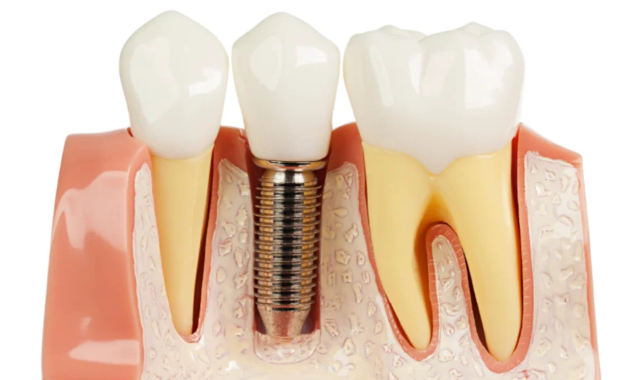 precio de los implantes dentales en Bogotá